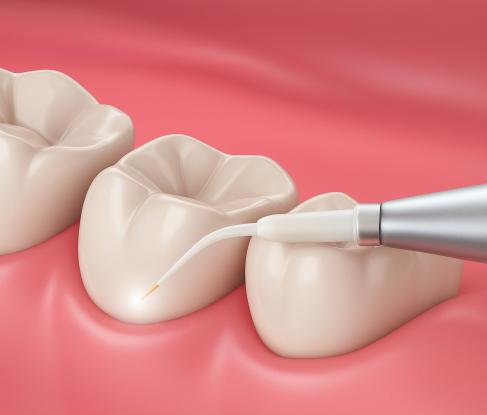 Removal using piezosurgery