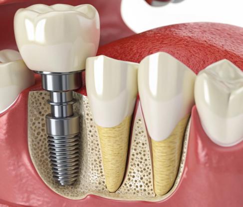 Bone grafting and augmentation