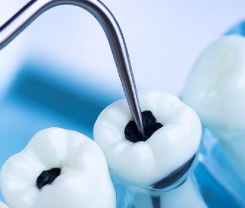 Treatment of caries and pulpitis in deciduous teeth